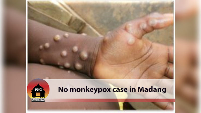 NO MONKEYPOX CASE