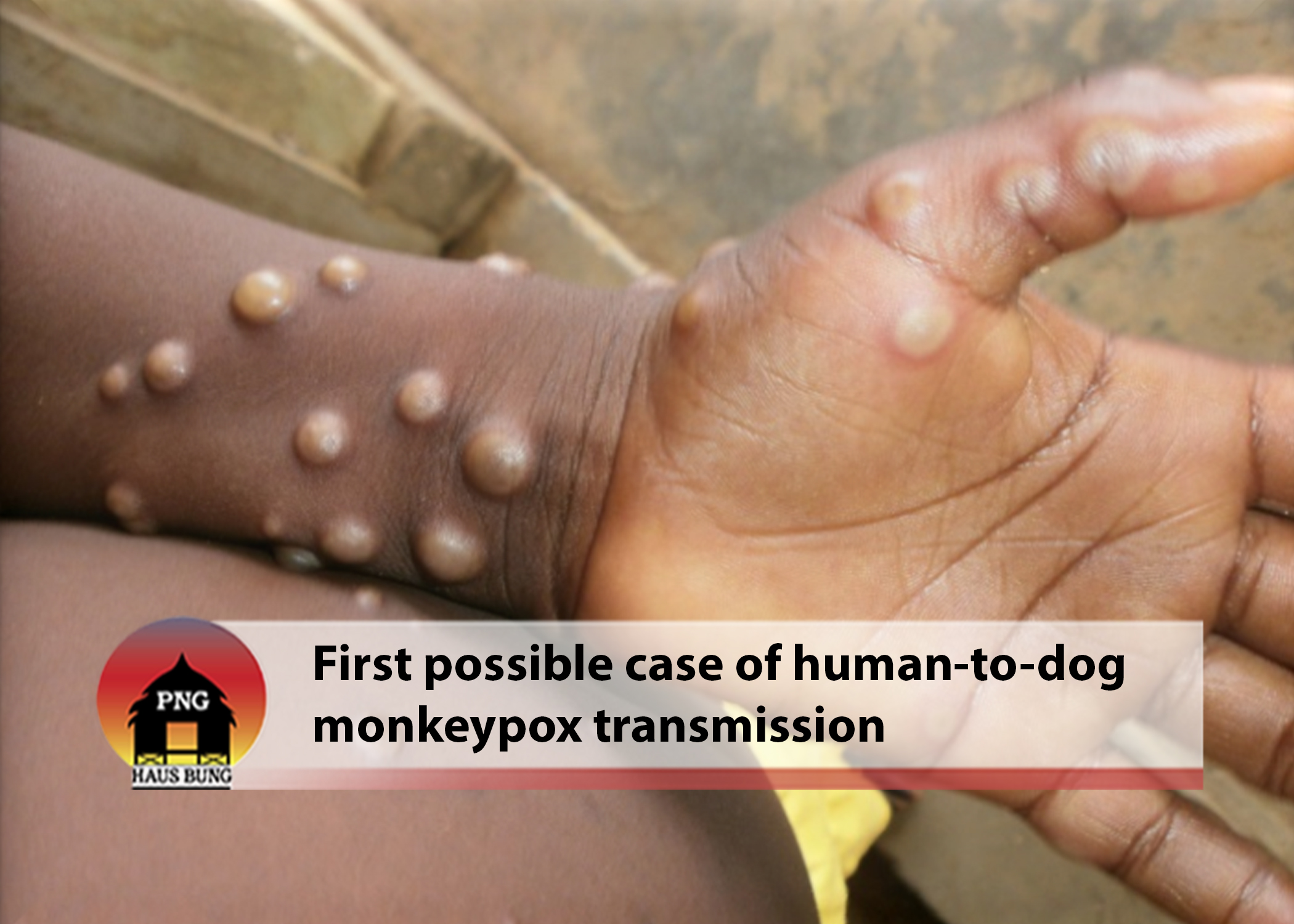 MONKEYPOX TRANSMISSION NEW BUT NOT SURPRISING