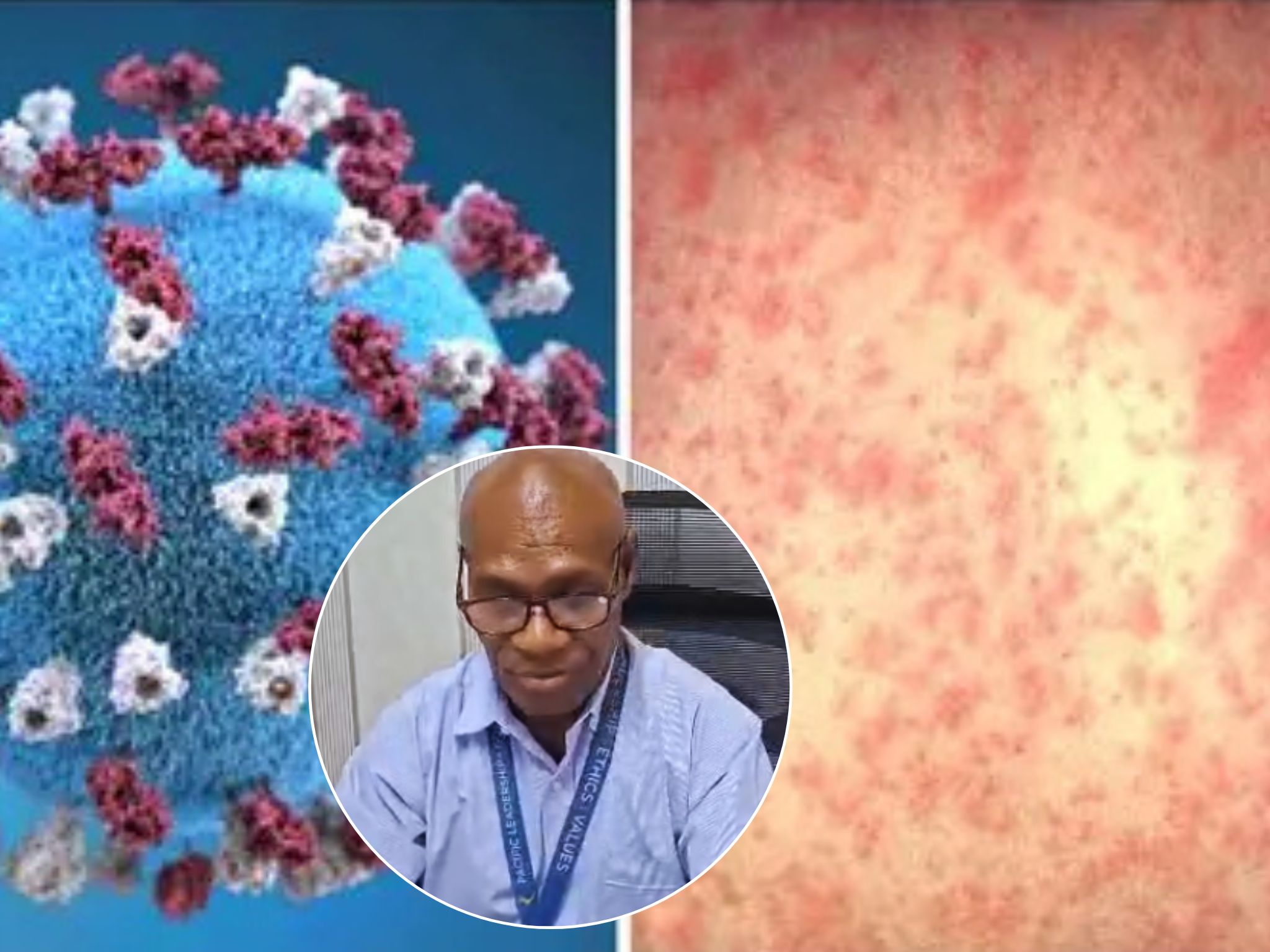NEW IRELAND PHA CONFIRMS MEASLES OUTBREAK